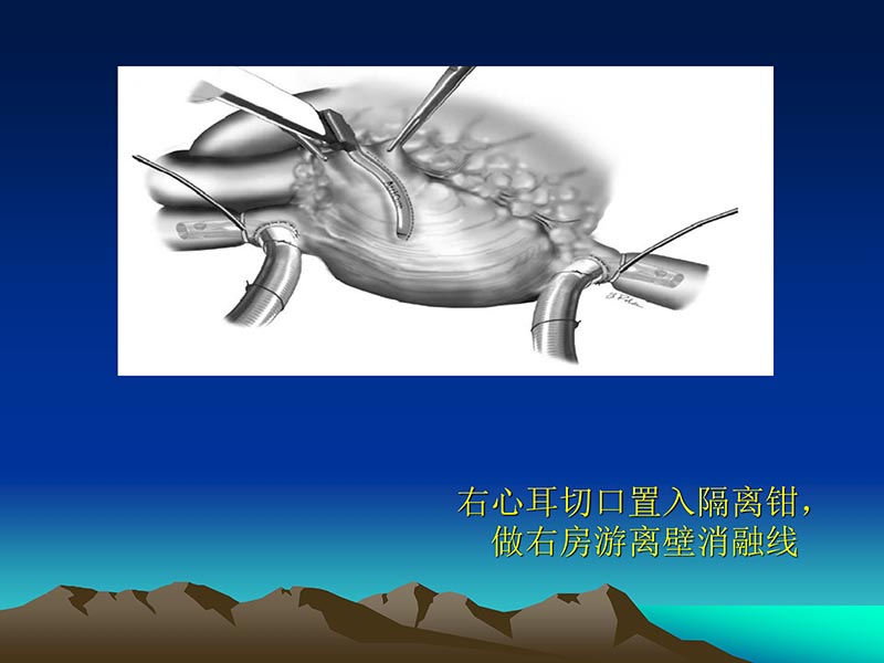 072812565383_02011-12-05心脏瓣膜外科的发展与现状_71.jpg
