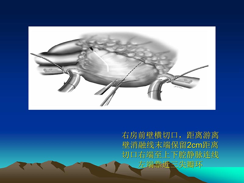072812565383_02011-12-05心脏瓣膜外科的发展与现状_72.jpg