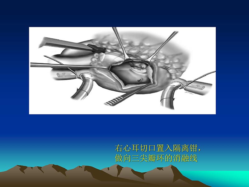 072812565383_02011-12-05心脏瓣膜外科的发展与现状_73.jpg