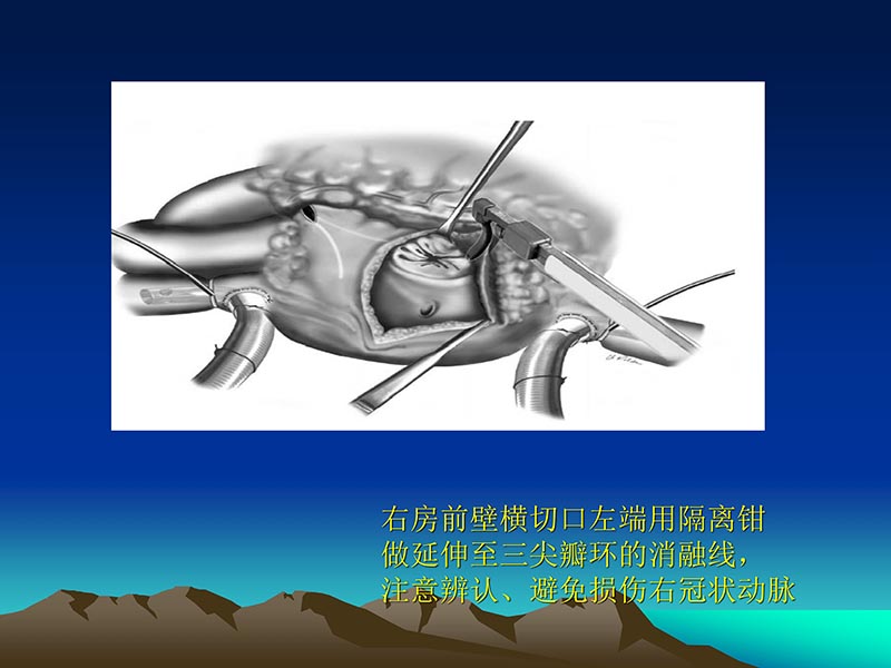 072812565383_02011-12-05心脏瓣膜外科的发展与现状_74.jpg
