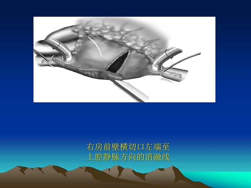 072812565383_02011-12-05心脏瓣膜外科的发展与现状_75.jpg