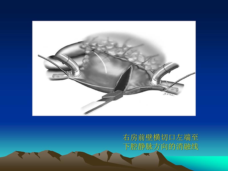 072812565383_02011-12-05心脏瓣膜外科的发展与现状_76.jpg