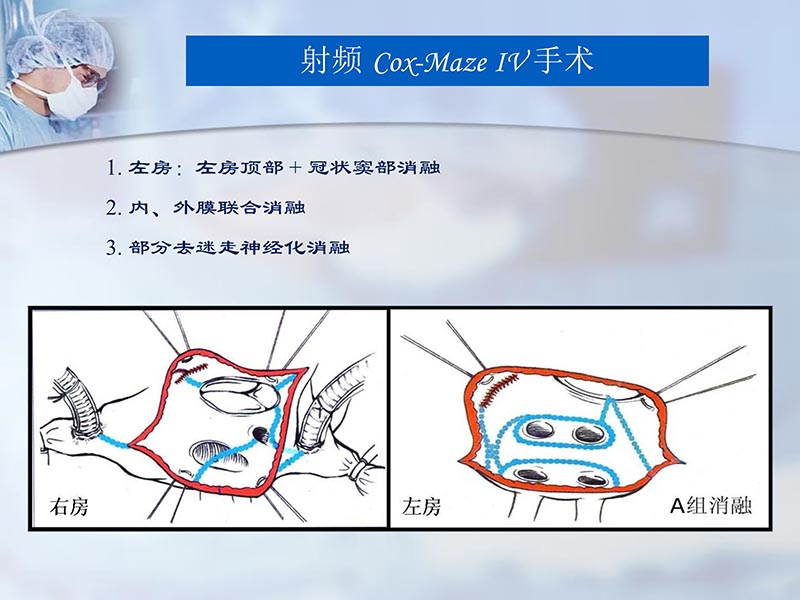 072812262445_02012-04-22微创外科治疗心房颤动_13.jpg