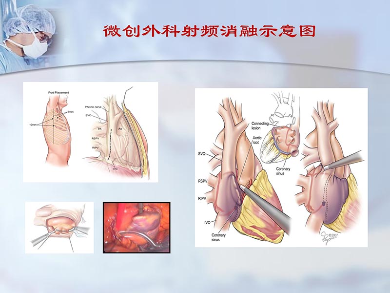 072812262445_02012-04-22微创外科治疗心房颤动_19.jpg