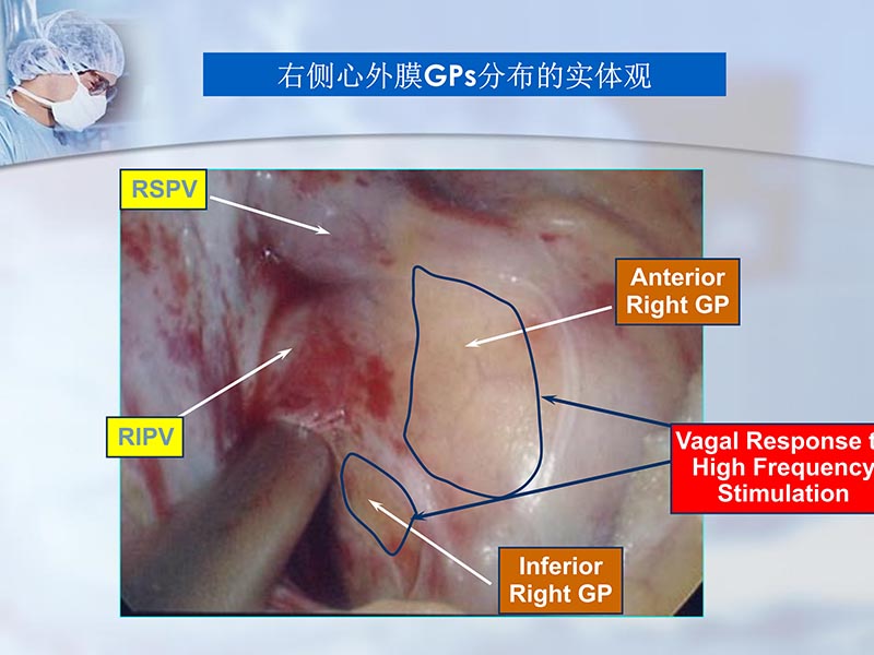 072812262445_02012-04-22微创外科治疗心房颤动_25.jpg