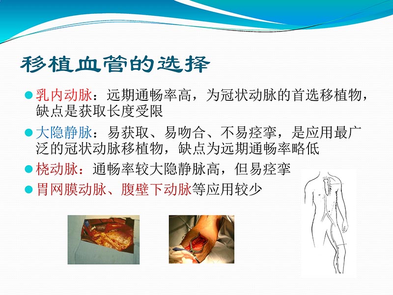 072813401993_02013-03-06微创冠状动脉搭桥治疗缺血性心脏病_13.jpg