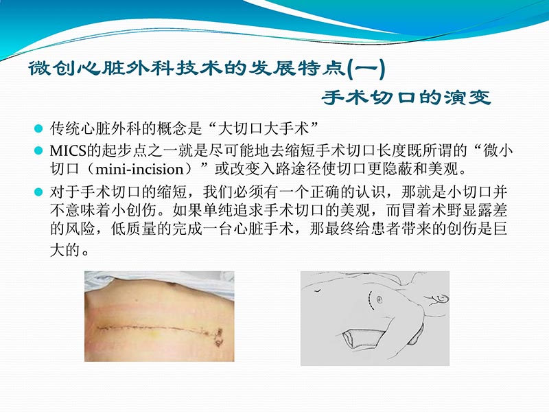072813401993_02013-03-06微创冠状动脉搭桥治疗缺血性心脏病_16.jpg