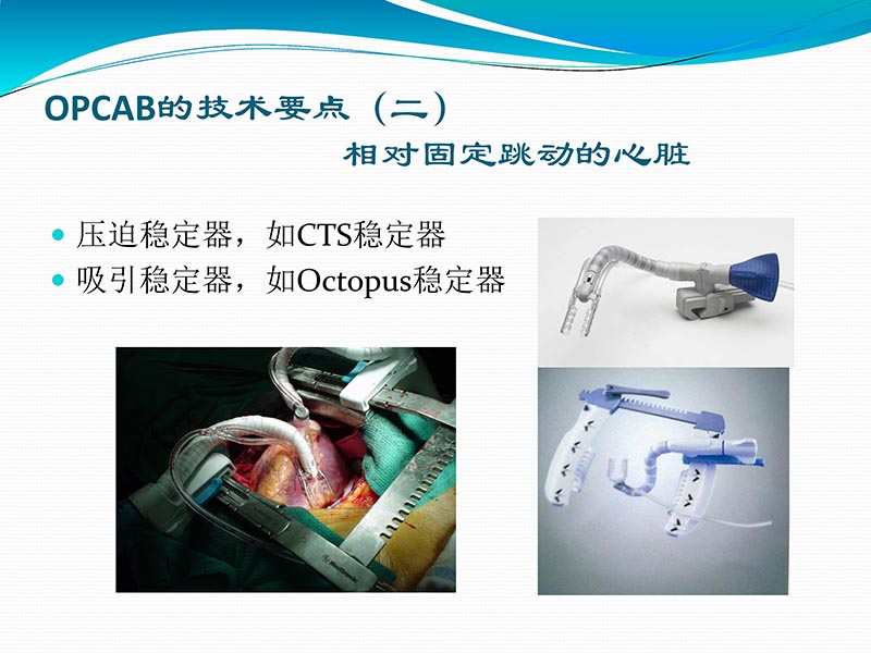 072813401993_02013-03-06微创冠状动脉搭桥治疗缺血性心脏病_23.jpg