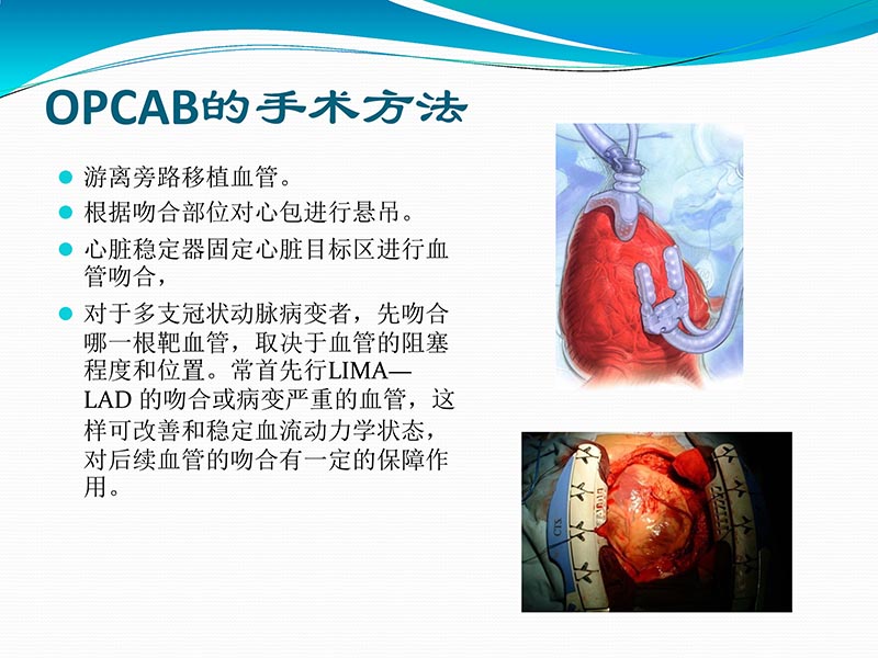 072813401993_02013-03-06微创冠状动脉搭桥治疗缺血性心脏病_26.jpg