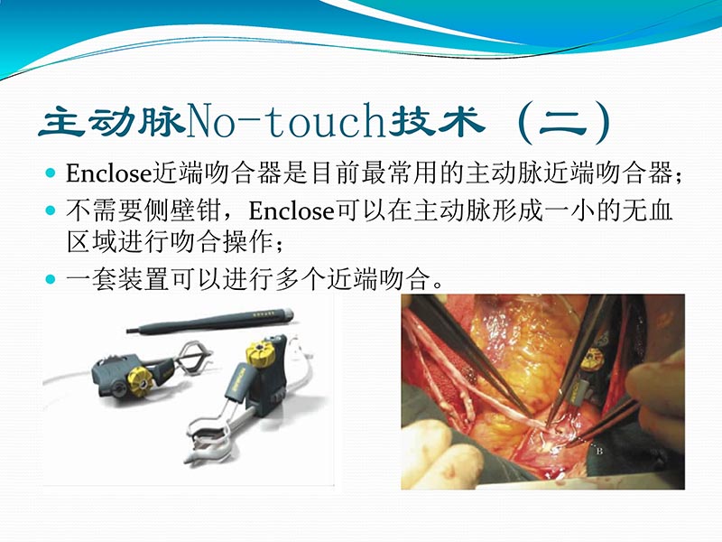 072813401993_02013-03-06微创冠状动脉搭桥治疗缺血性心脏病_30.jpg