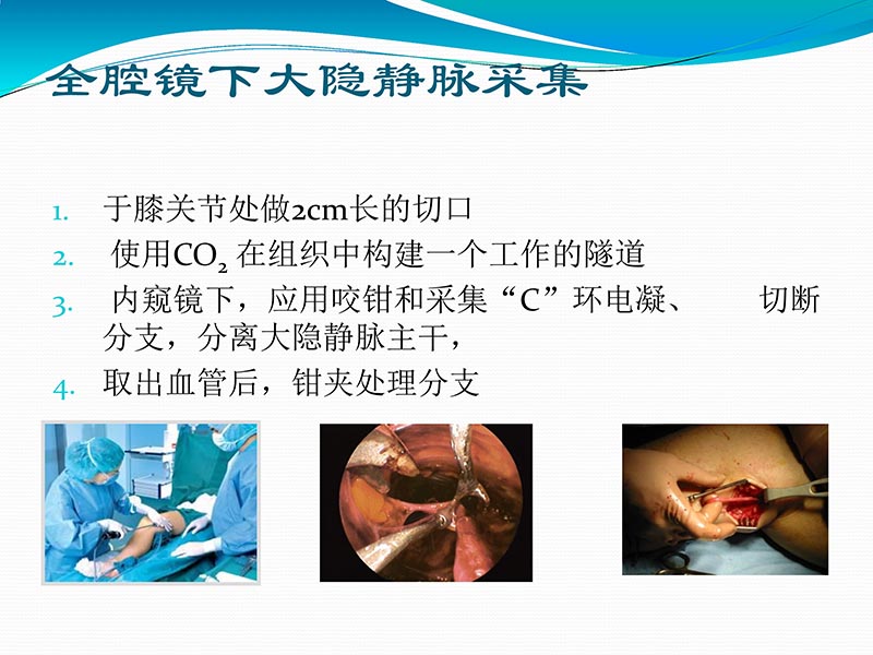 072813401993_02013-03-06微创冠状动脉搭桥治疗缺血性心脏病_31.jpg