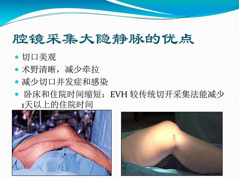 072813401993_02013-03-06微创冠状动脉搭桥治疗缺血性心脏病_32.jpg