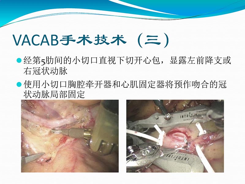 072813401993_02013-03-06微创冠状动脉搭桥治疗缺血性心脏病_42.jpg