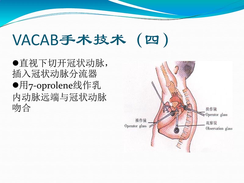 072813401993_02013-03-06微创冠状动脉搭桥治疗缺血性心脏病_43.jpg