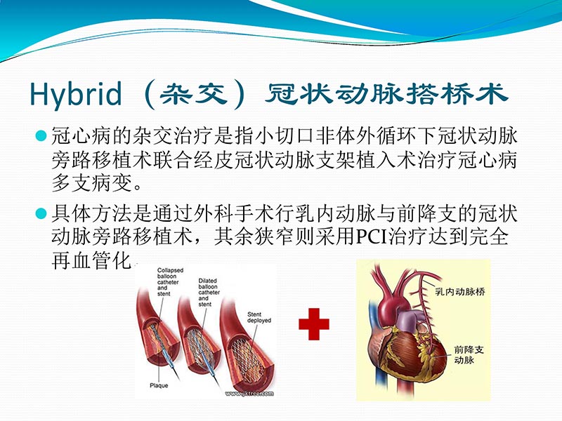 072813401993_02013-03-06微创冠状动脉搭桥治疗缺血性心脏病_48.jpg
