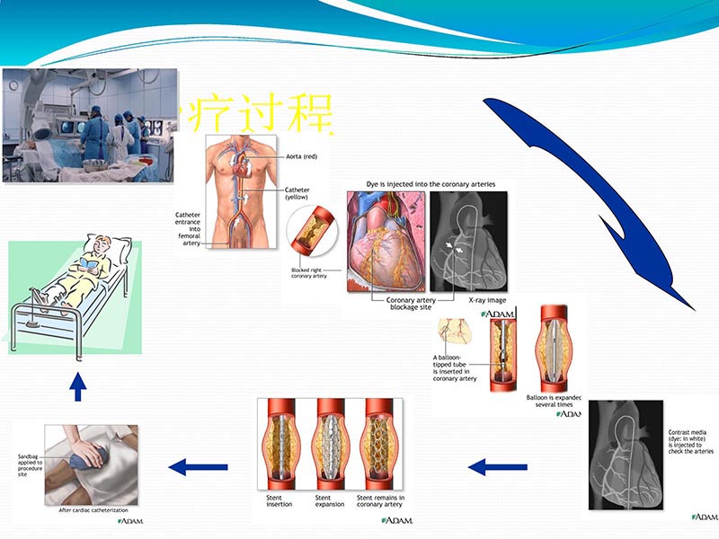 072813401993_02013-03-06微创冠状动脉搭桥治疗缺血性心脏病_65.jpg
