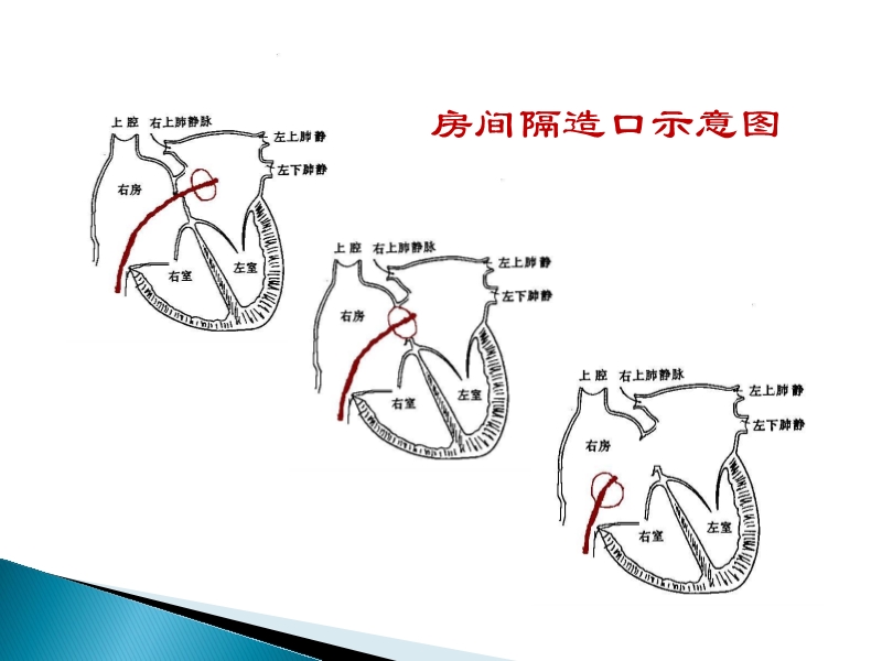 072815373246_02014-08-26先天性心脏病诊治现况_22.jpg