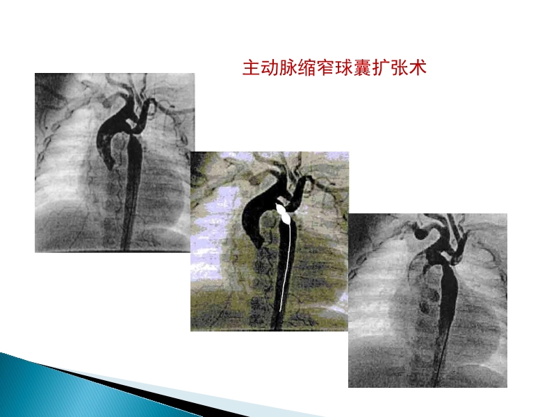 072815373246_02014-08-26先天性心脏病诊治现况_23.jpg