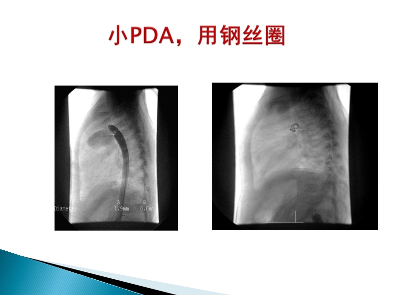 072815373246_02014-08-26先天性心脏病诊治现况_27.jpg
