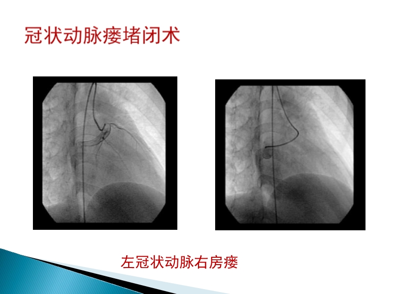 072815373246_02014-08-26先天性心脏病诊治现况_32.jpg
